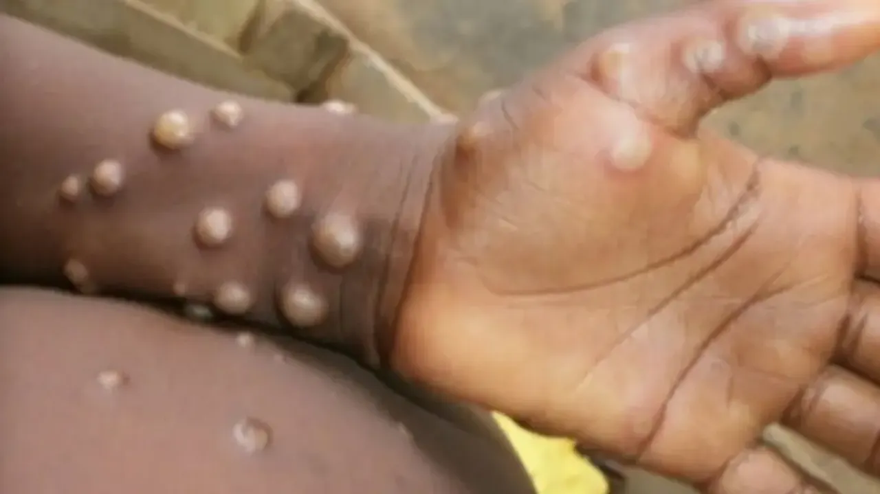 Monkeypox