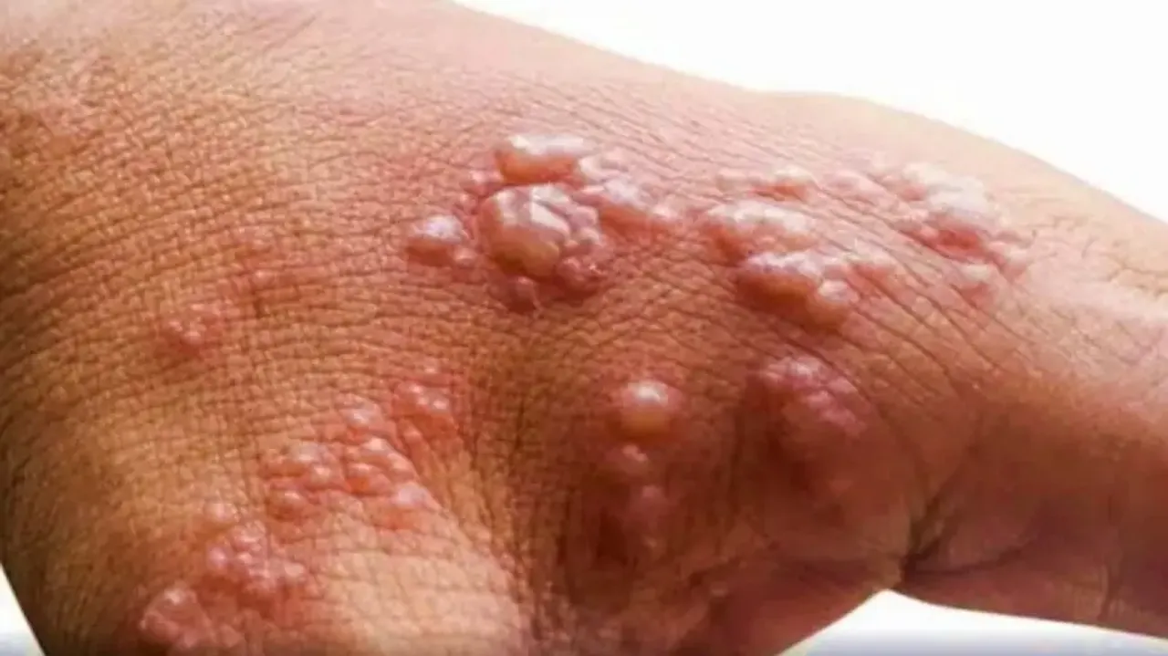 Monkeypox
