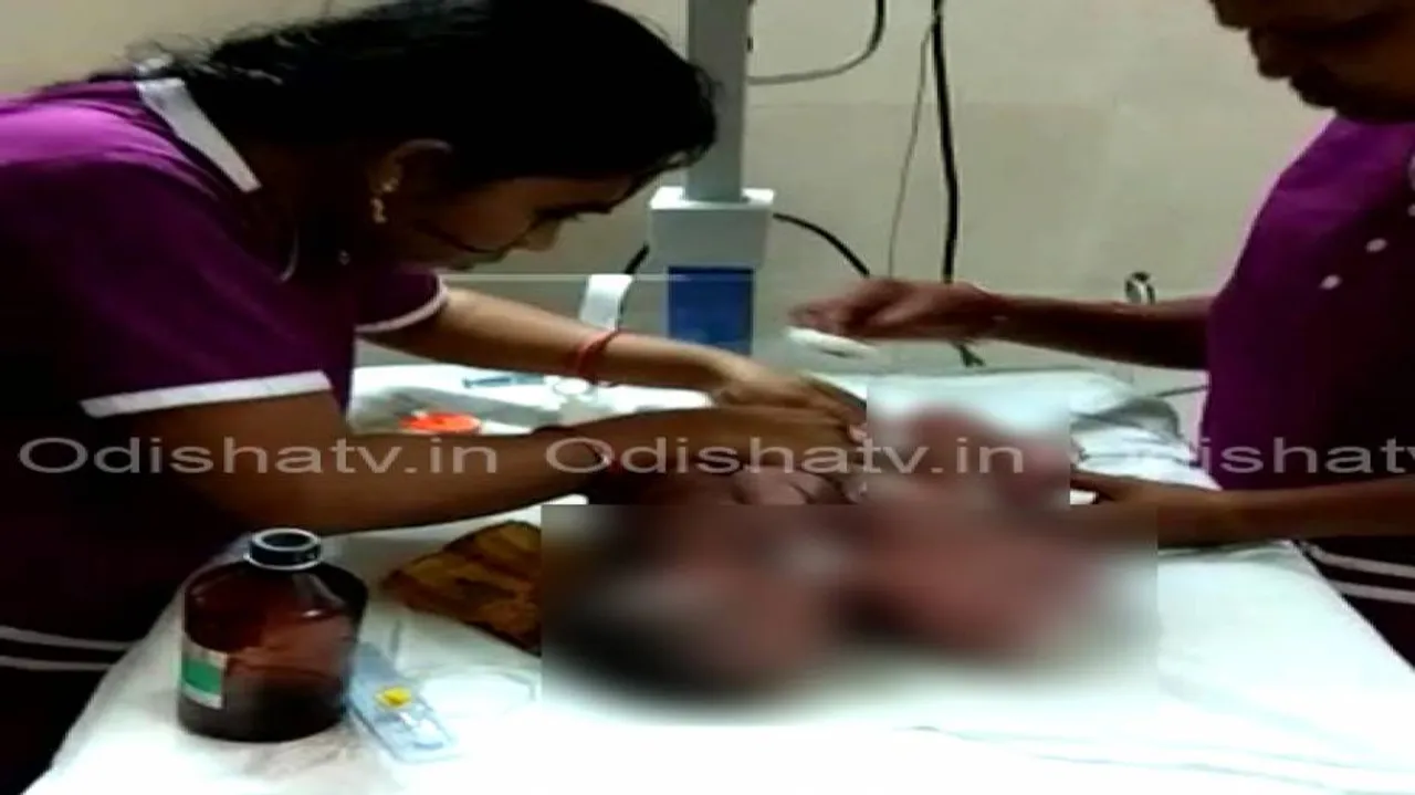 Nayagarh conjoined twins share one heart, liver