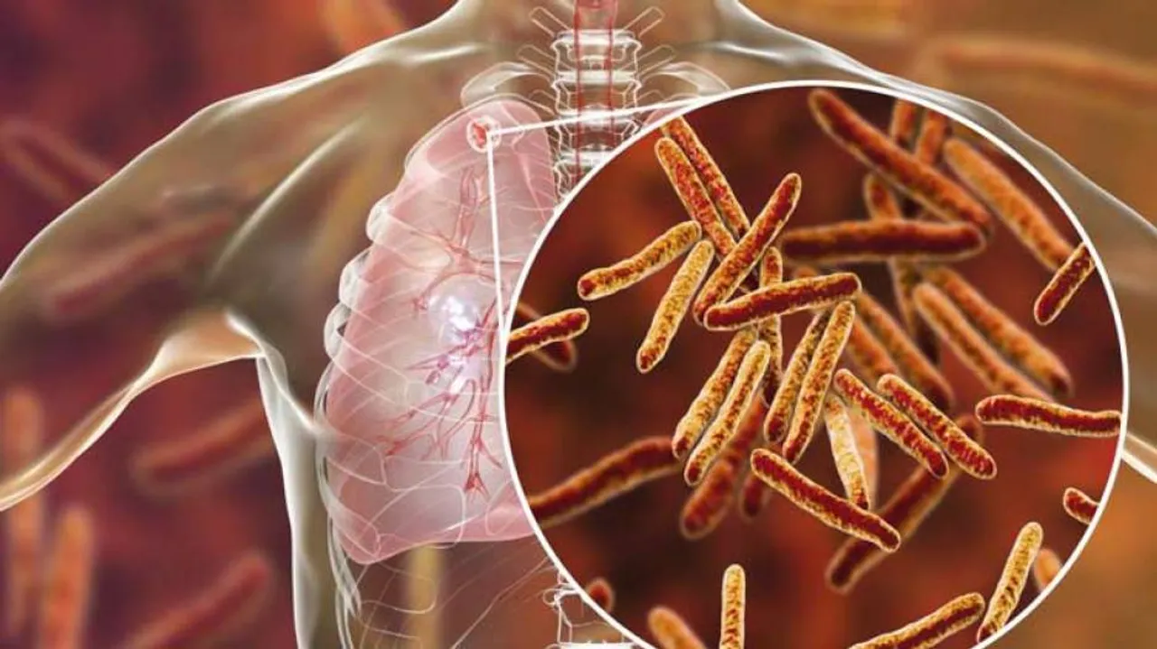 21.5 lakh TB cases reported in India in 2018: Report