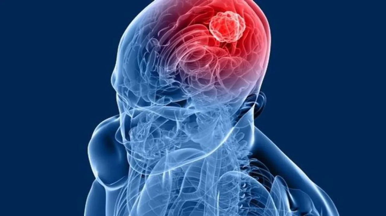 Brain tumour no longer scary, say doctors