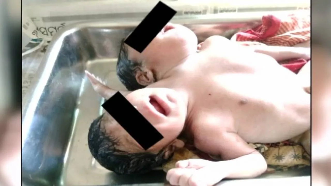 Rare Two-Headed Baby Girl Born In Odisha, Admitted To Sishu Bhawan