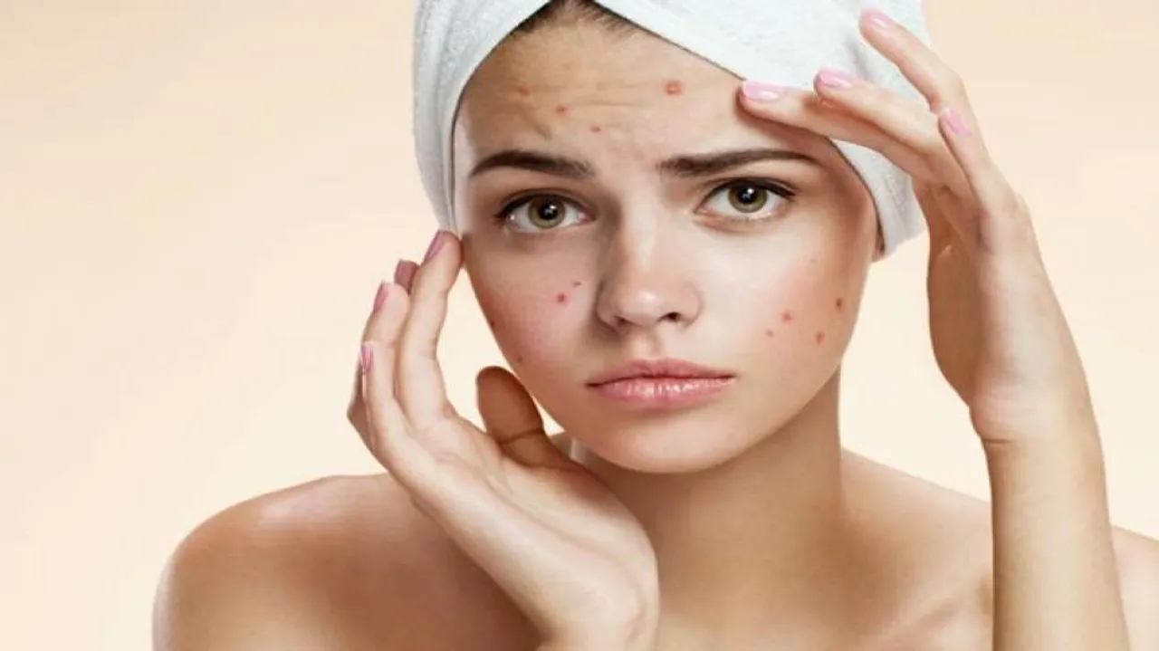 Keep acne at bay