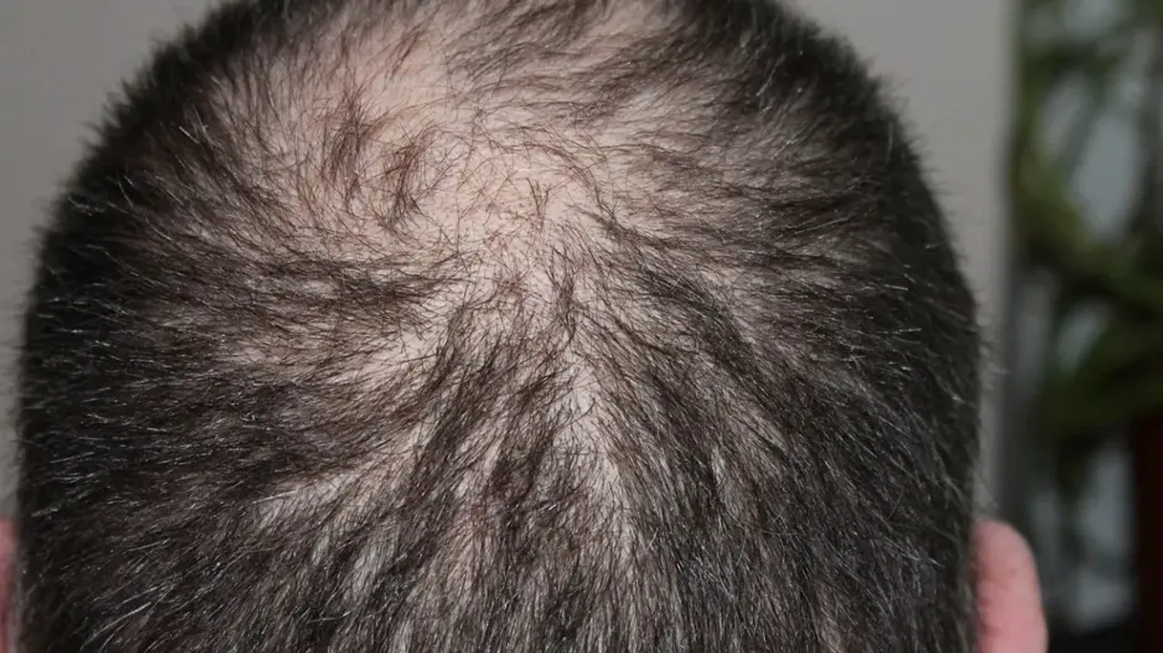 baldness