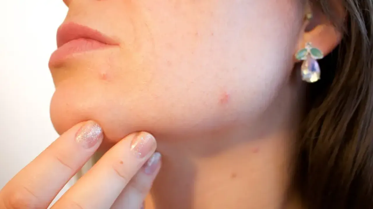 blackheads