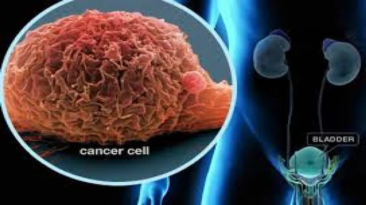 Urine test can lead to better bladder cancer treatment