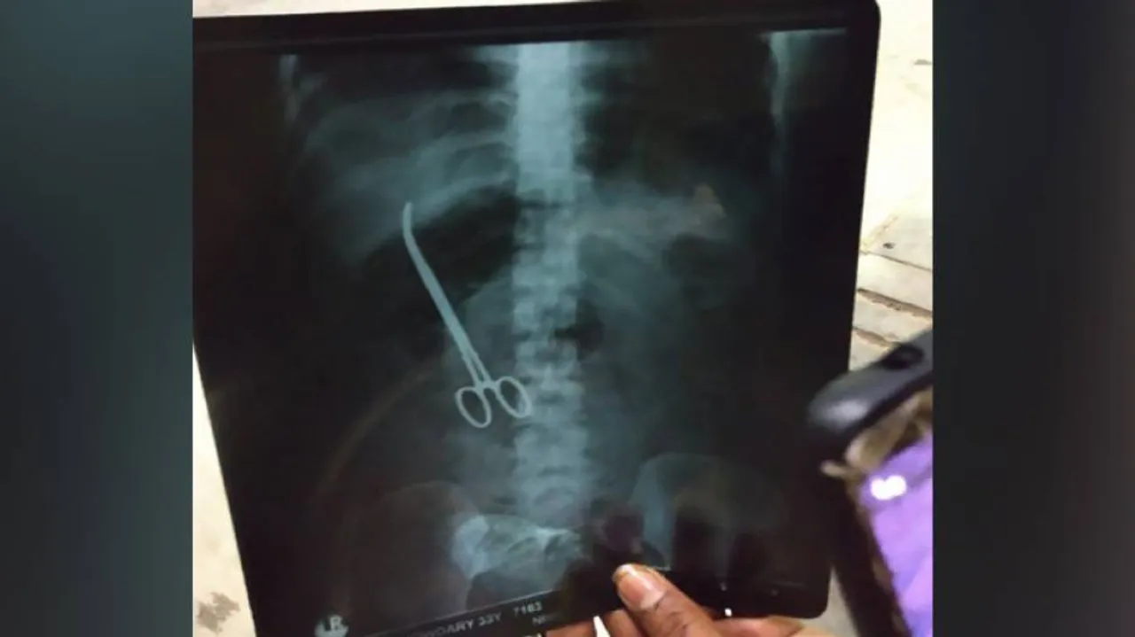 Doctors at Hyderabad's NIMS leave forceps in patient's abdomen