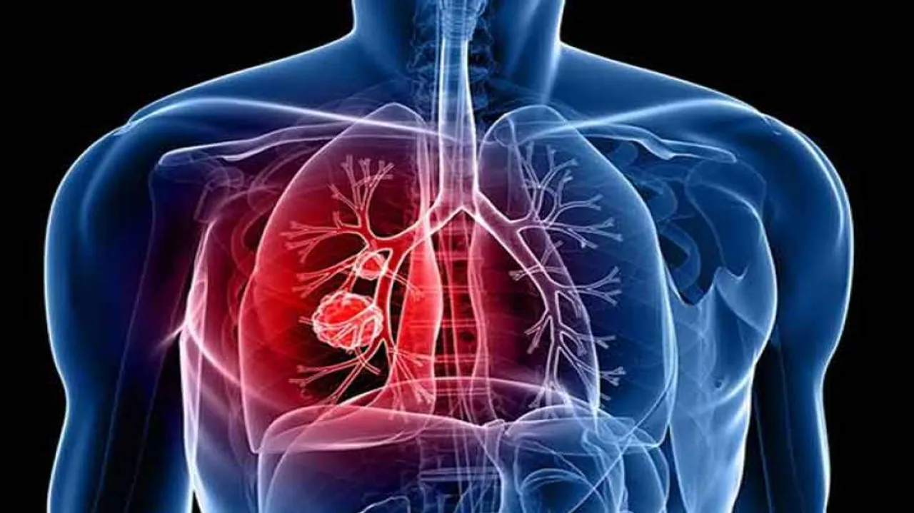 This Artificial Intelligence system spots often-missed lung cancer tumours