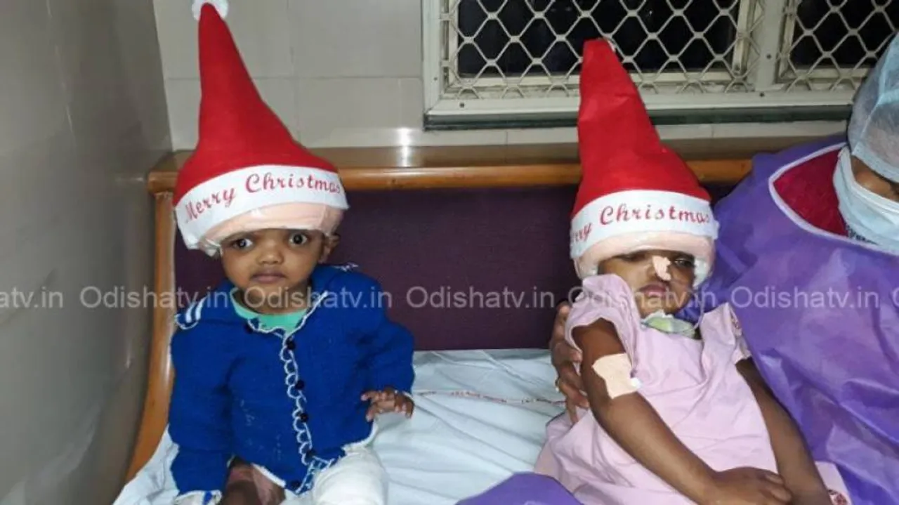 Separated conjoined twins: Kalia on ventilator