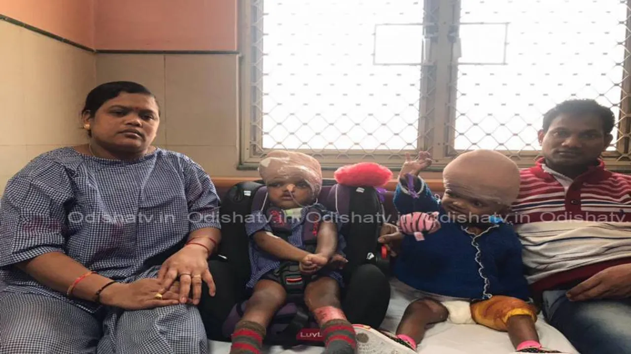 When Jaga met Kalia for the first time after separation surgery