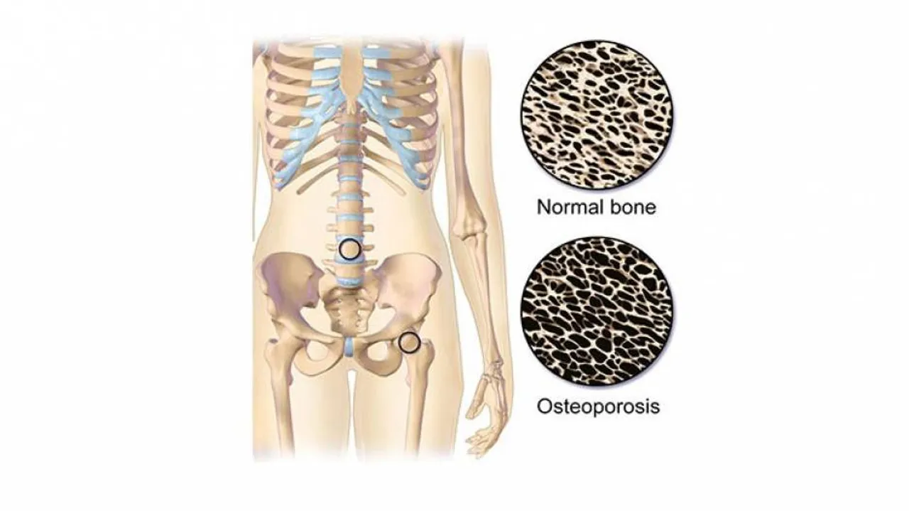 Vitamin D Deficiency Lead To Higher Osteoporosis & Poor Bone Health