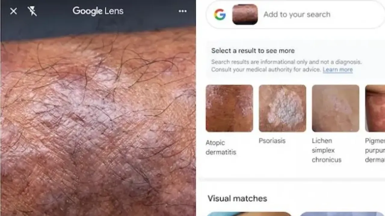 How Google Lens helps identify skin conditions and more, know here