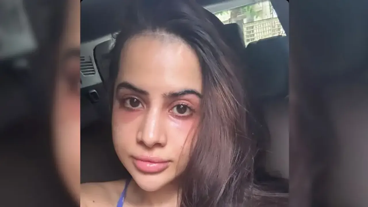 Urfi Javed's under-eye fillers go wrong: 'Why did I do this to myself?'
