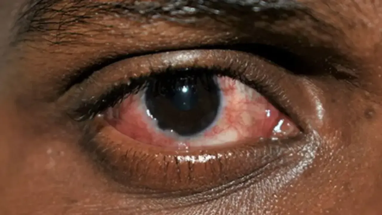 Doctors see 40% rise in viral conjunctivitis among kids, adults