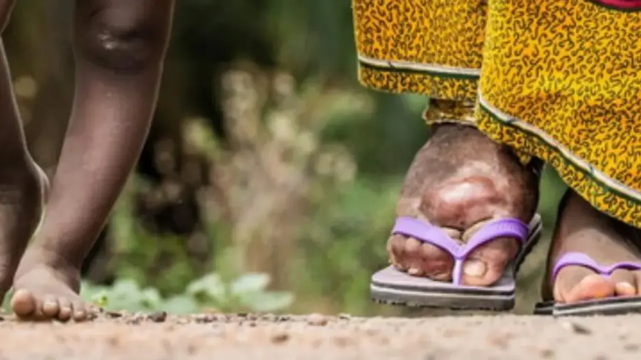 India committed to eliminating lymphatic filariasis by 2027: Mandaviya