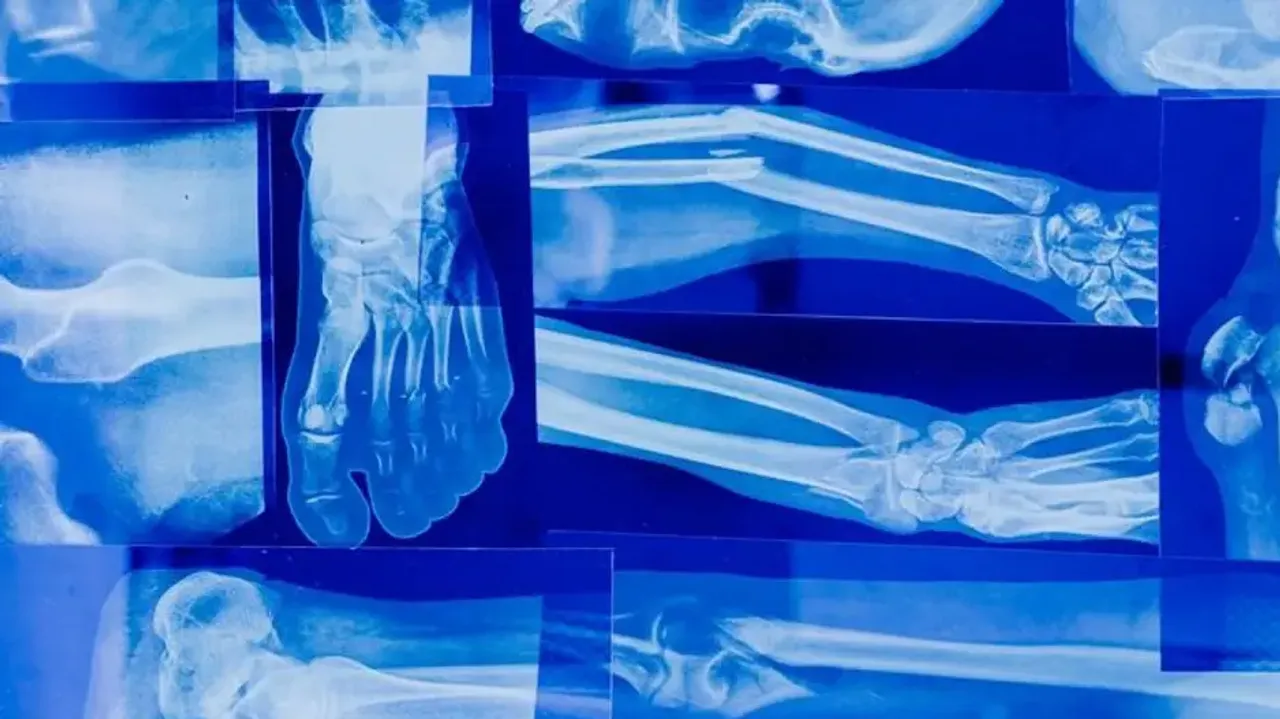 Signs that indicate your bones are weak