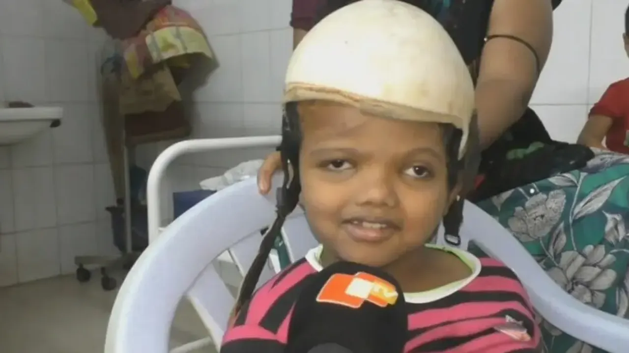 Conjoined twin survivor Jaga