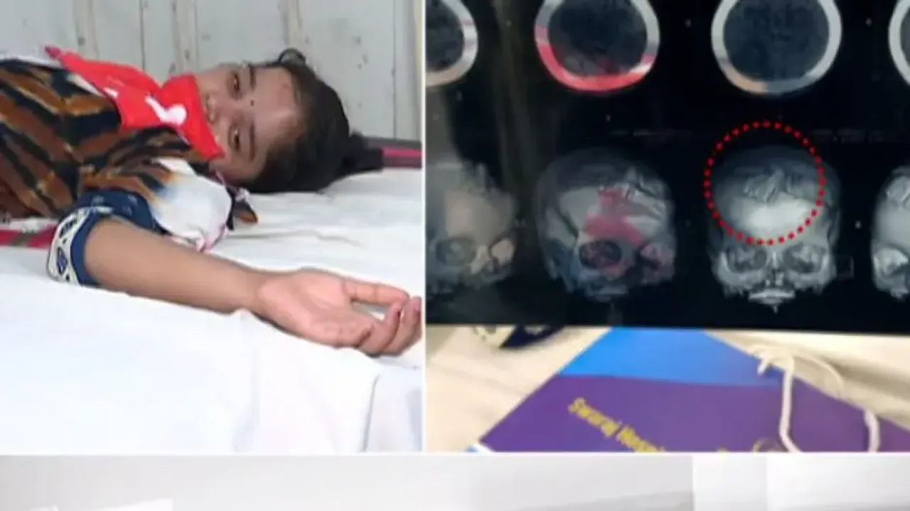 Tantrik pierces multiple needles inside girl’s head in Bolangir, arrested
