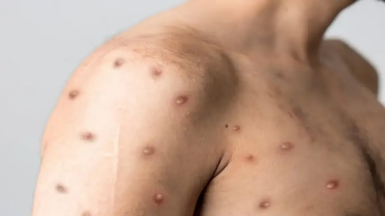 First MPox case confirmed in Kerala 