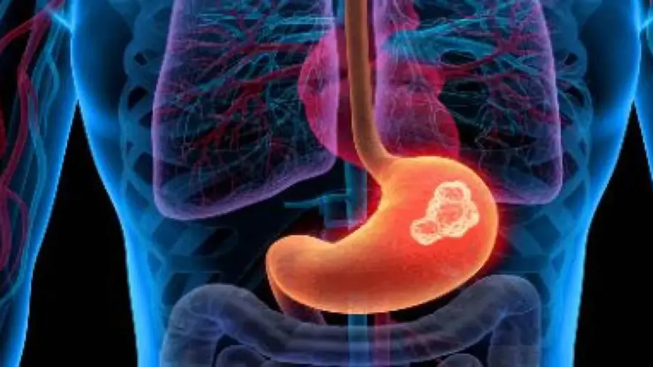 New method to detect ulcer, gastric cancer-causing bacteria