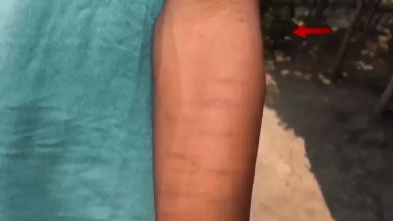 Inhumane! ‘Class 6 student’s hand cut, salt rubbed on wound’ in Odisha hostel 
