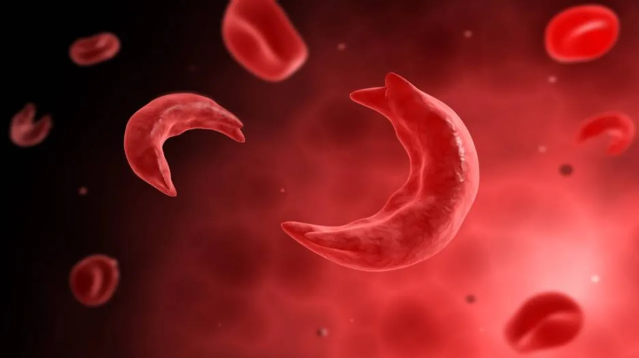 Odisha seeks national institute for sickle cell disorder