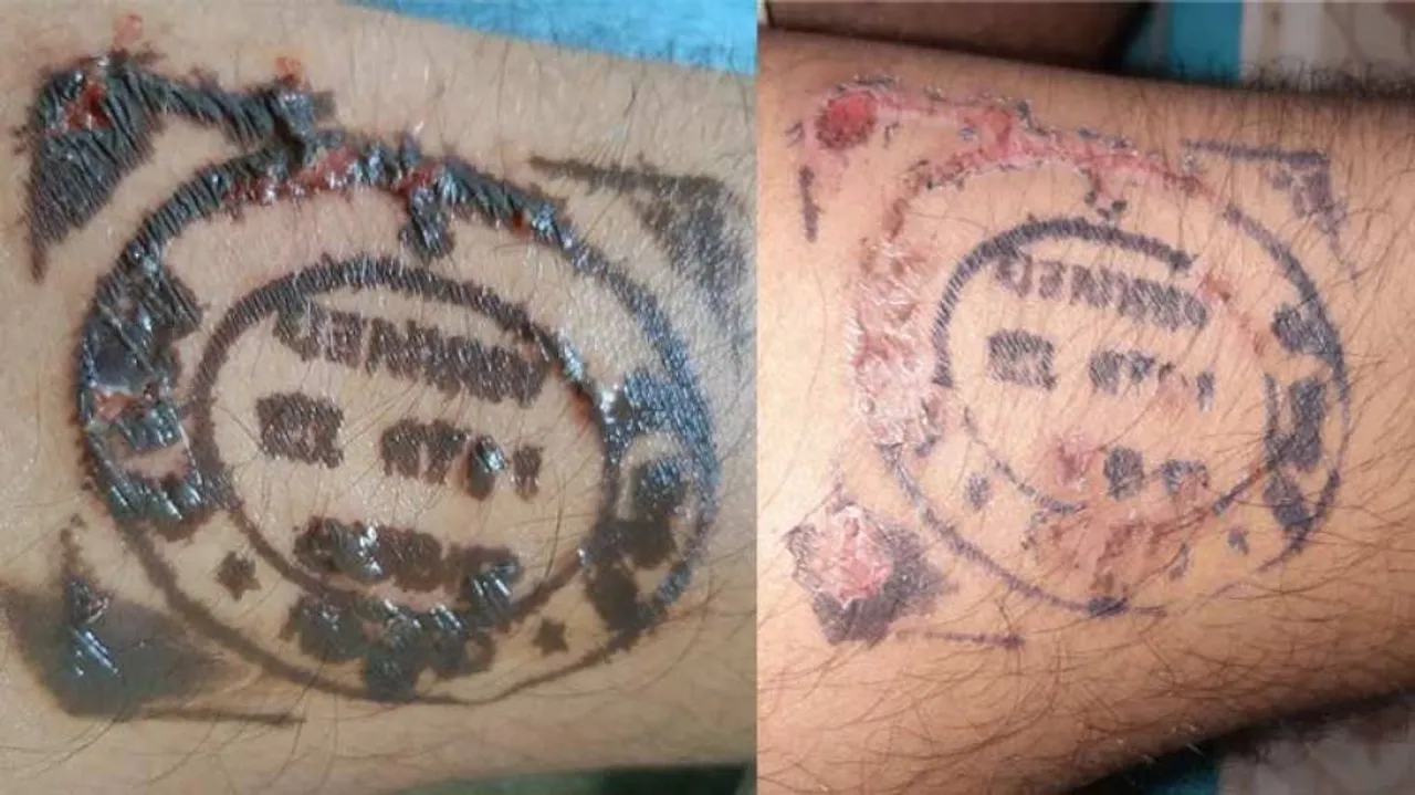 Odisha Returnees Fume After Quarantine Stamp Leaves Skin Burns, Blisters