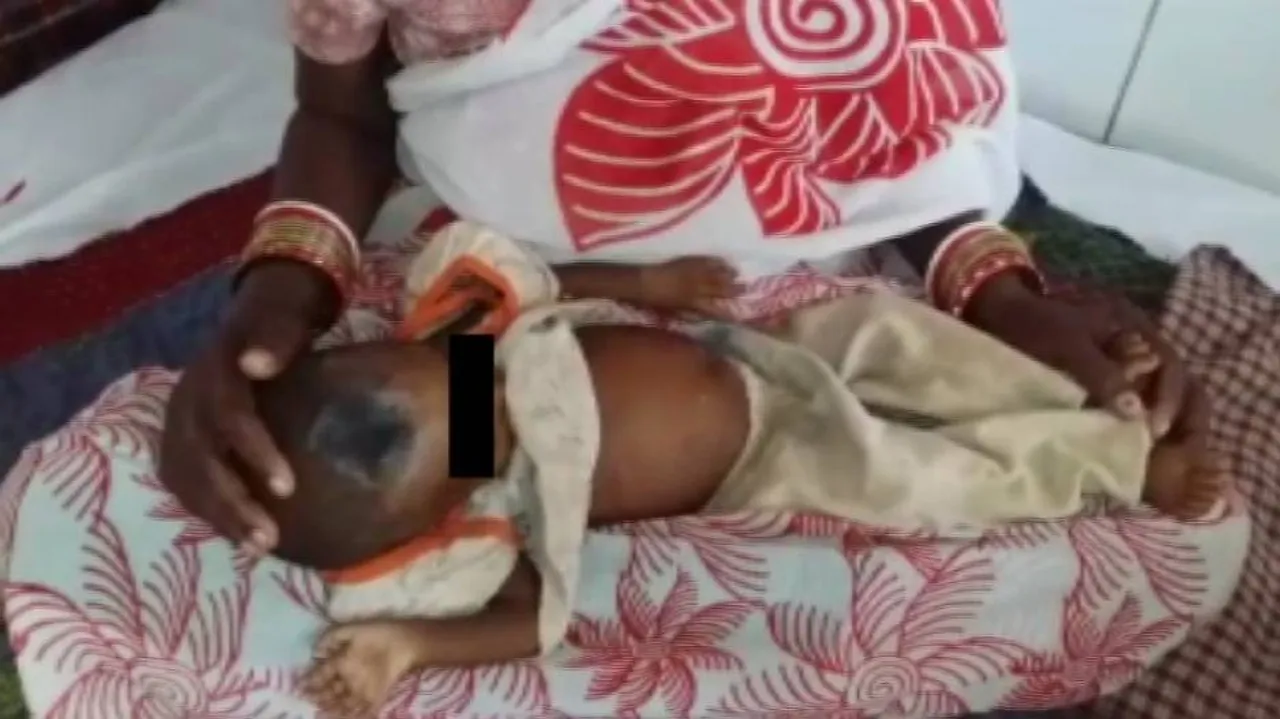 One-yr-old girl branded with hot iron to cure illness