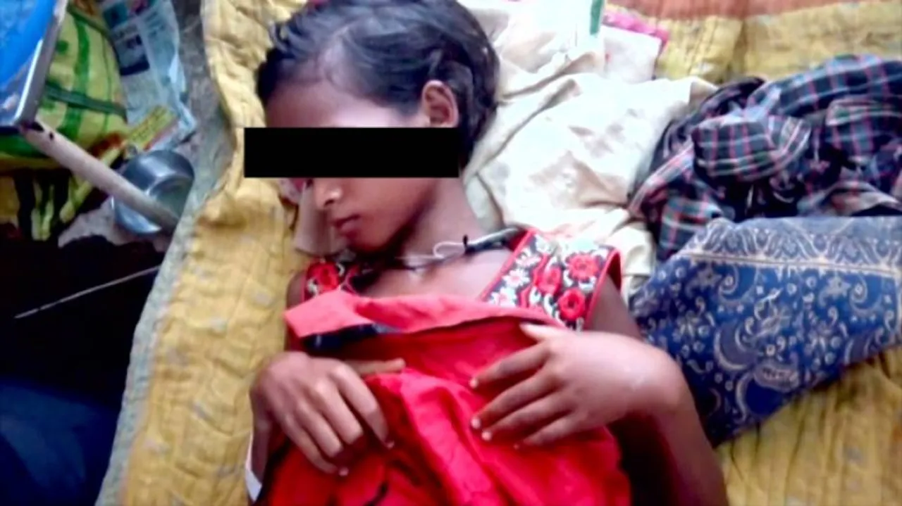 Superstition continues in Keonjhar; 10-year-old girl branded with hot iron