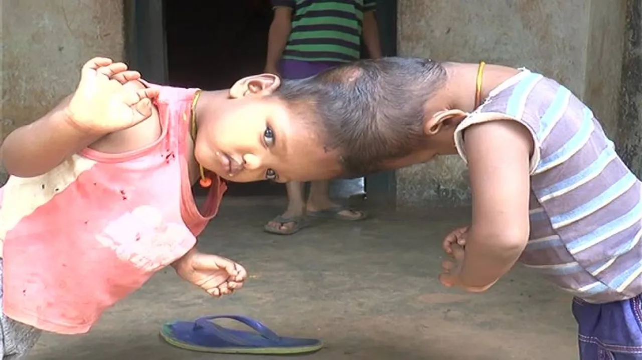Conjoined twins of Kandhamal reach SCB for treatment