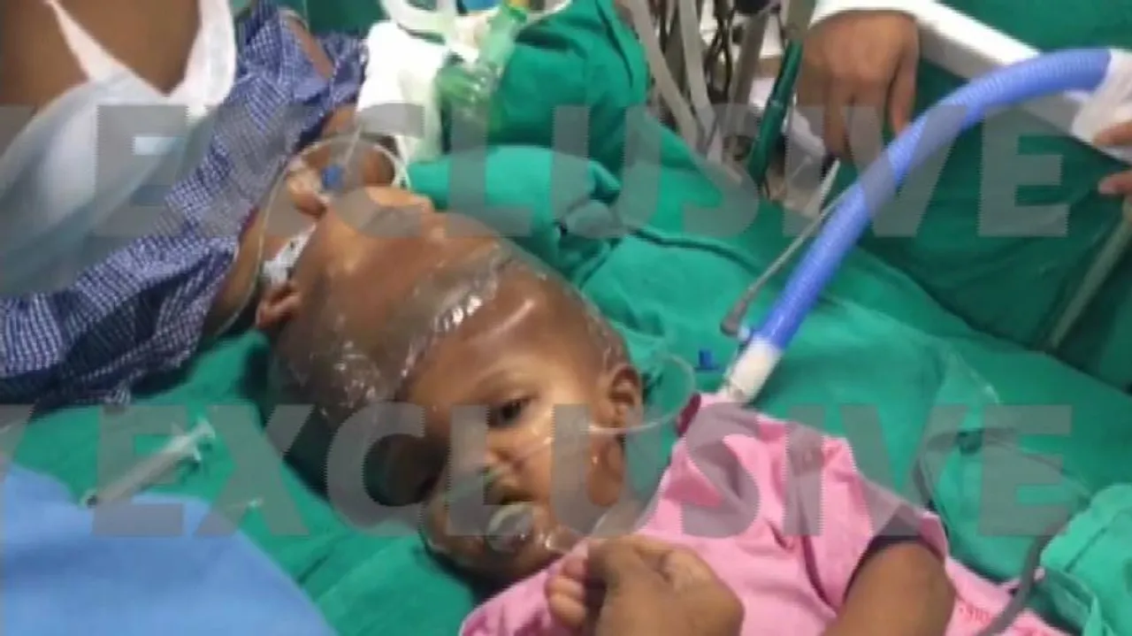 Conjoined twins Jaga-Kalia moved to general ward in AIIMS Delhi
