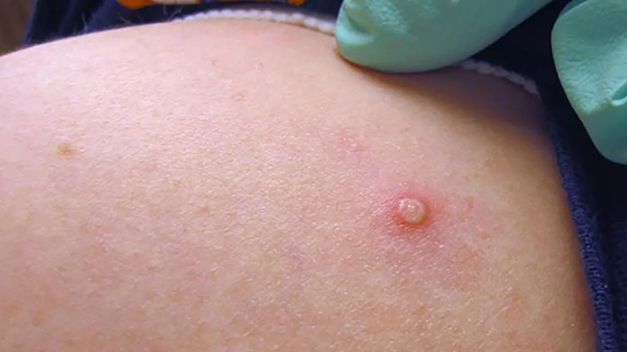 Prevent Monkeypox Spread 