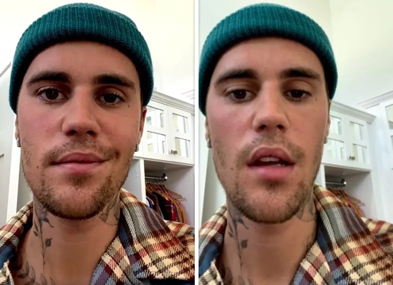 Pop Star Justin Bieber Suffers from Facial Paralyses 