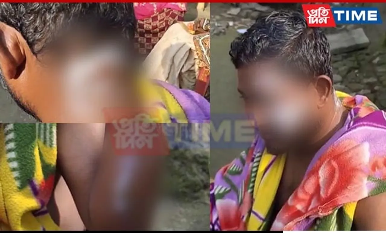 Fruit Vendor Attacked with Acid in Assam Over Payment Dispute