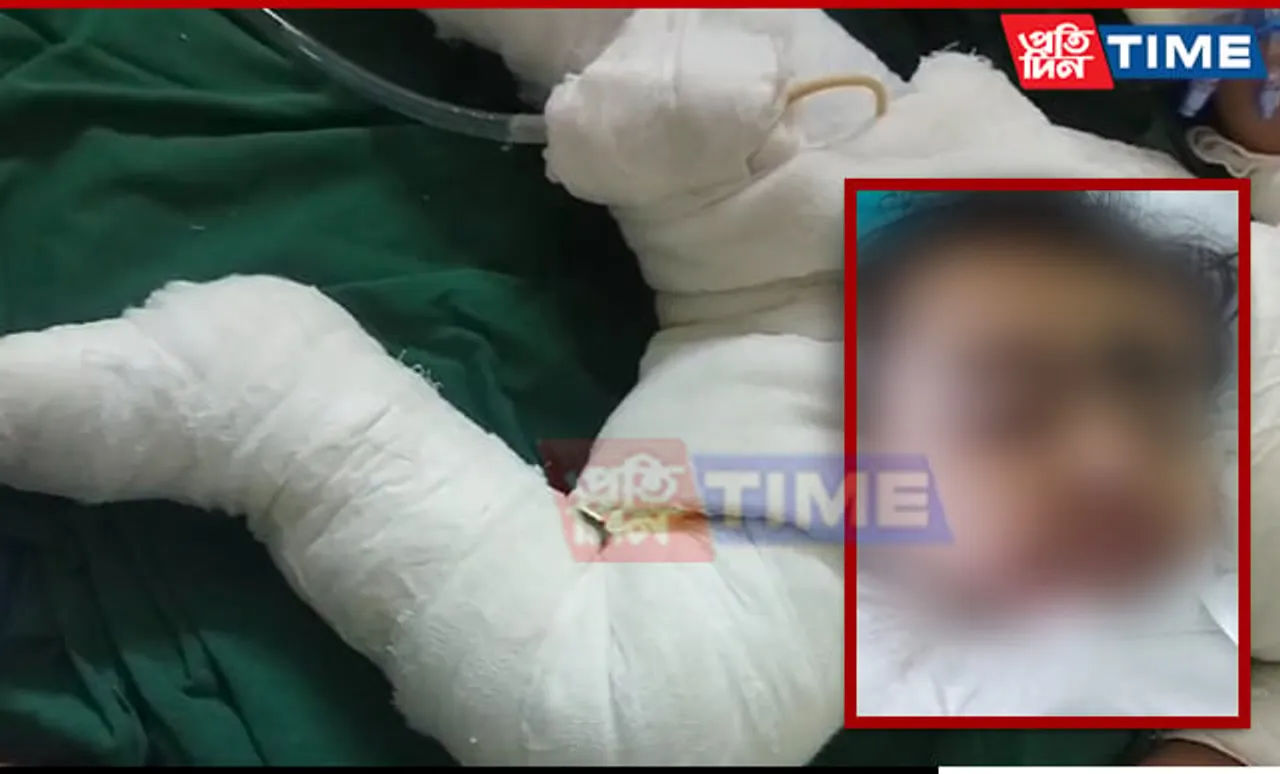 Toddler Suffers Severe Burns After Falling Into Frying Vessel in Assam's Barpeta