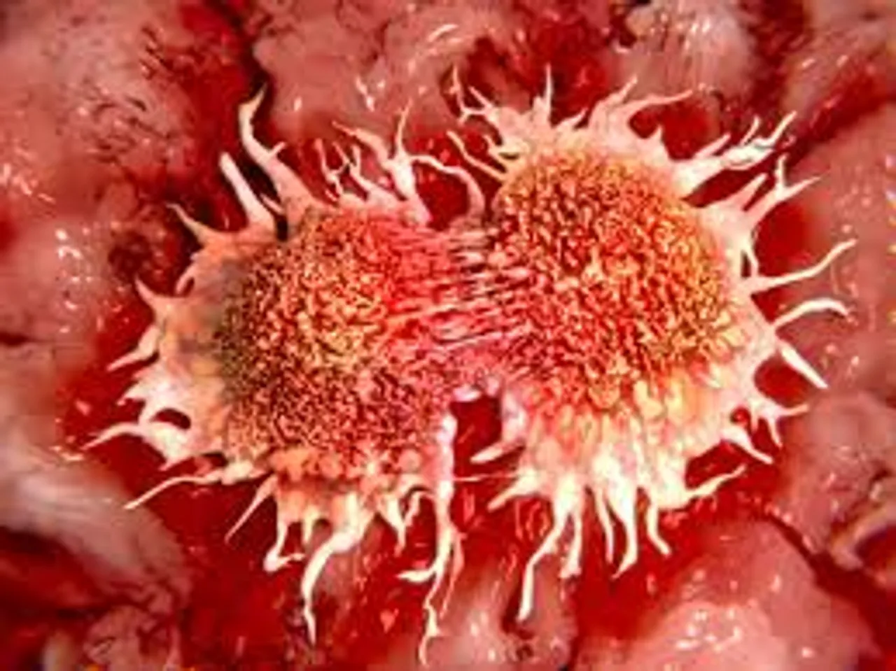 70% cancer in Assam detected late