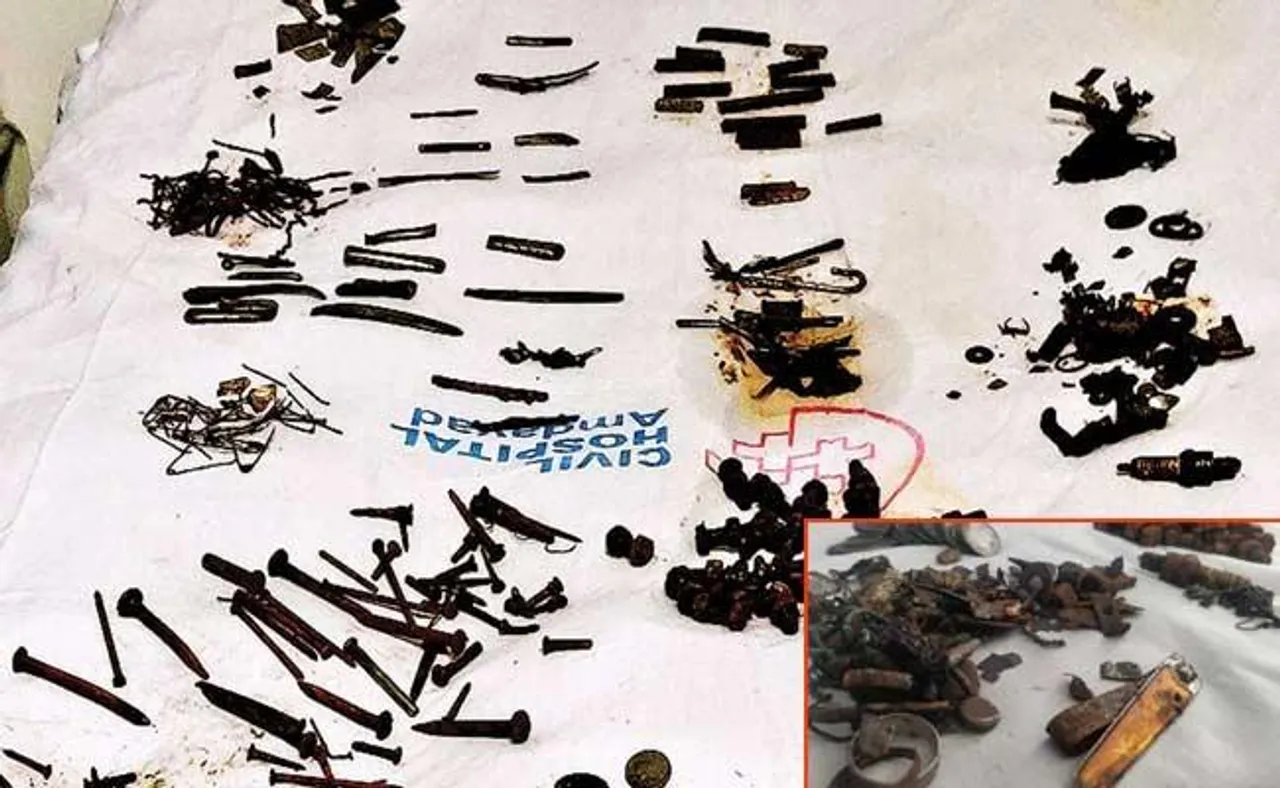 Ahmedabad: 452 Metal Items Operated From Man’s Stomach