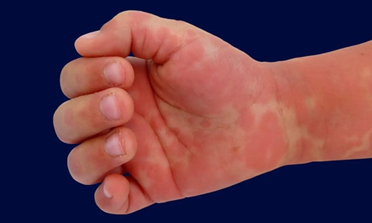 COVID19: Delhi Hospitals Report Multi Inflammatory Syndrome in Children