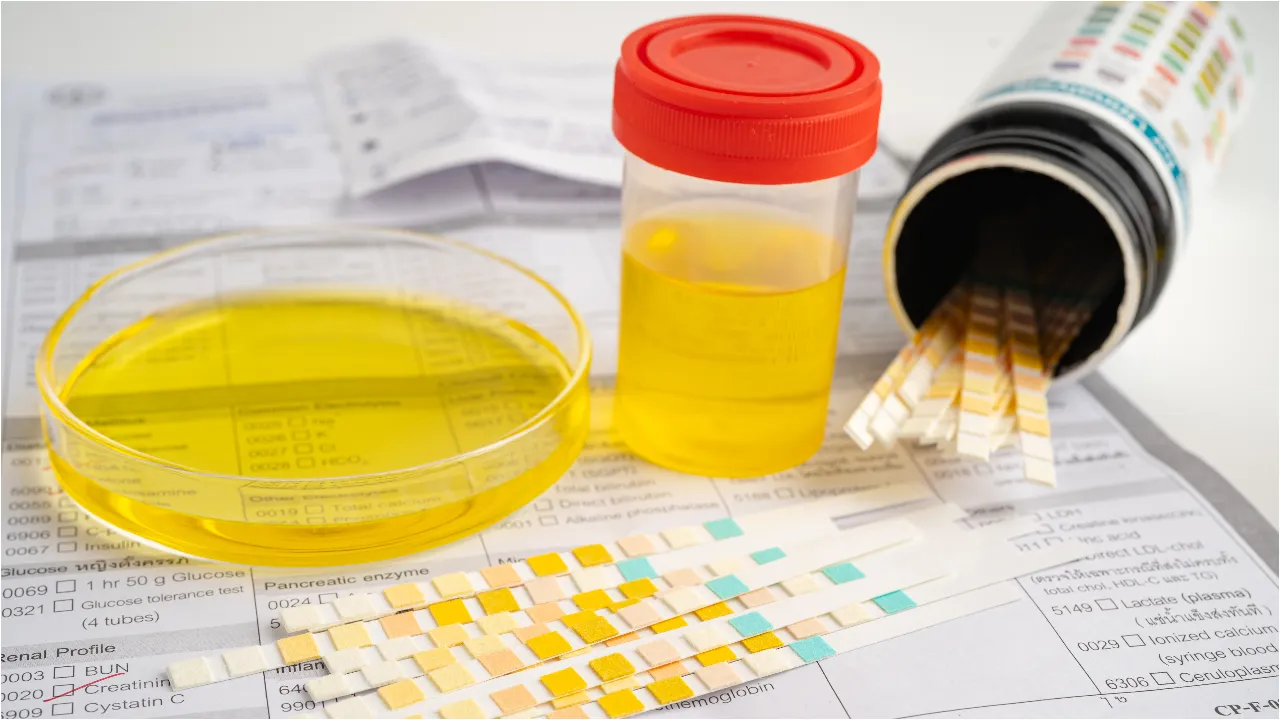 yellow urine 