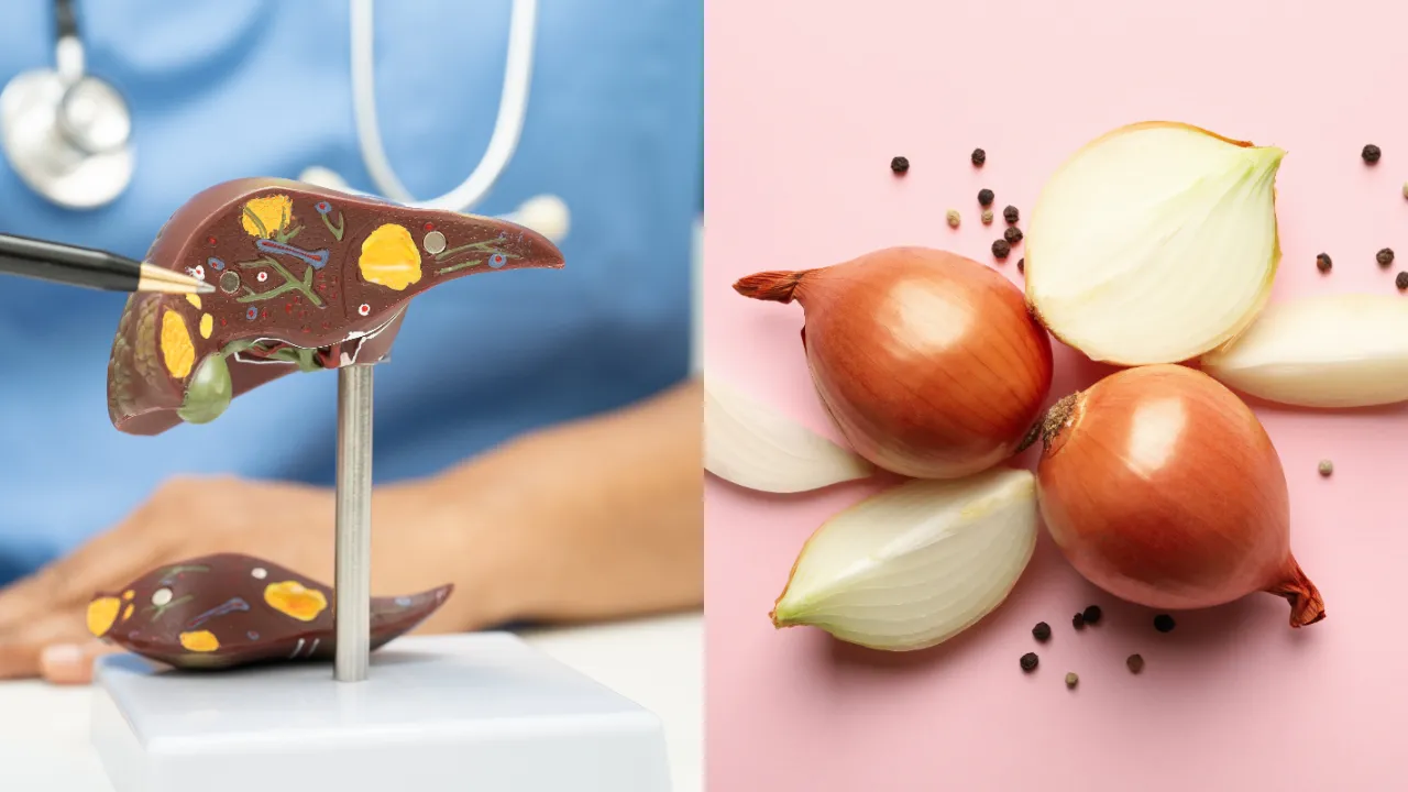 onion- fatty liver 