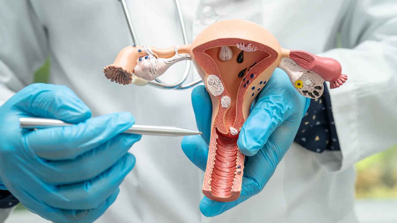 Uterine Cancer