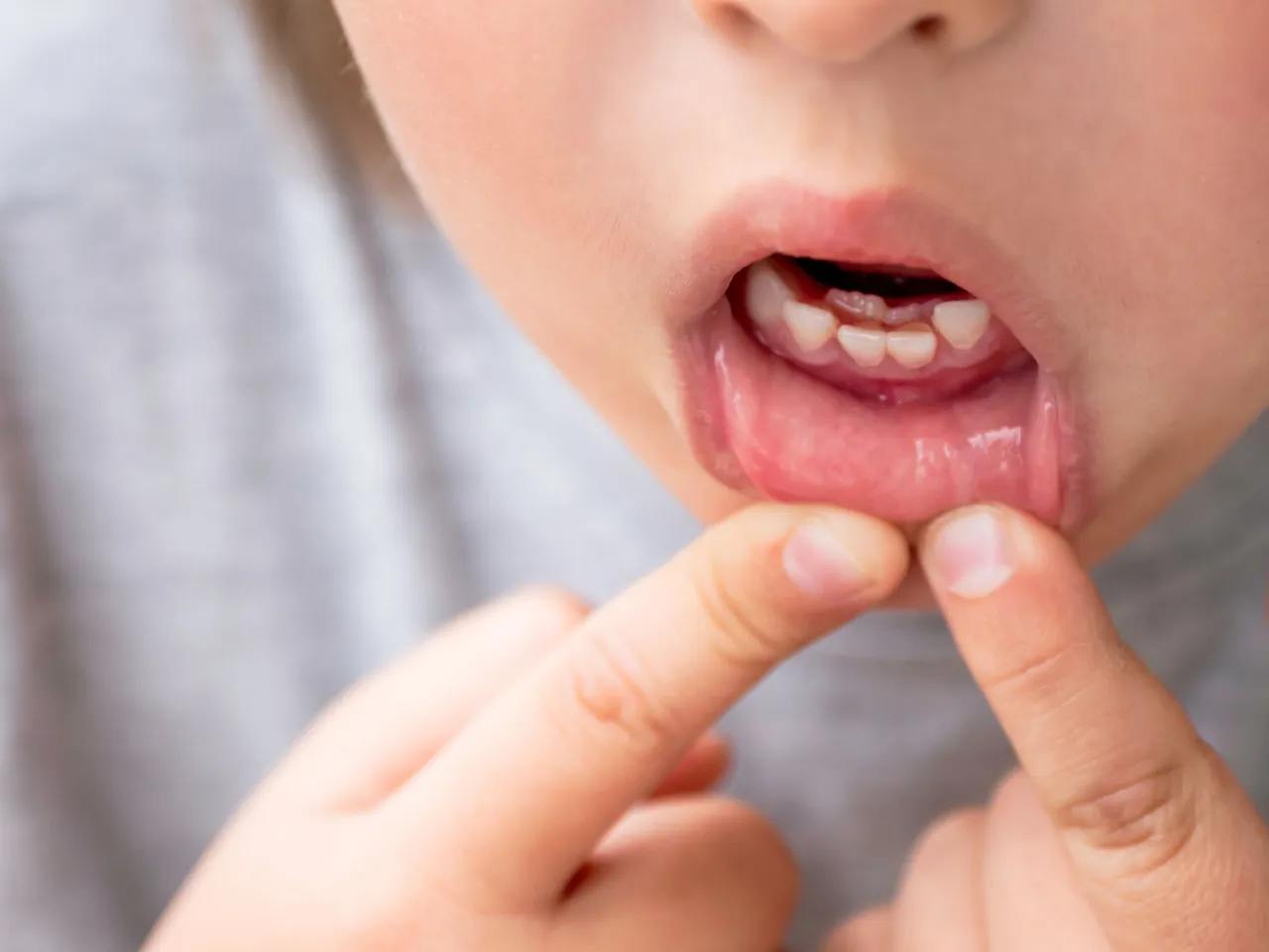 mouth ulcers