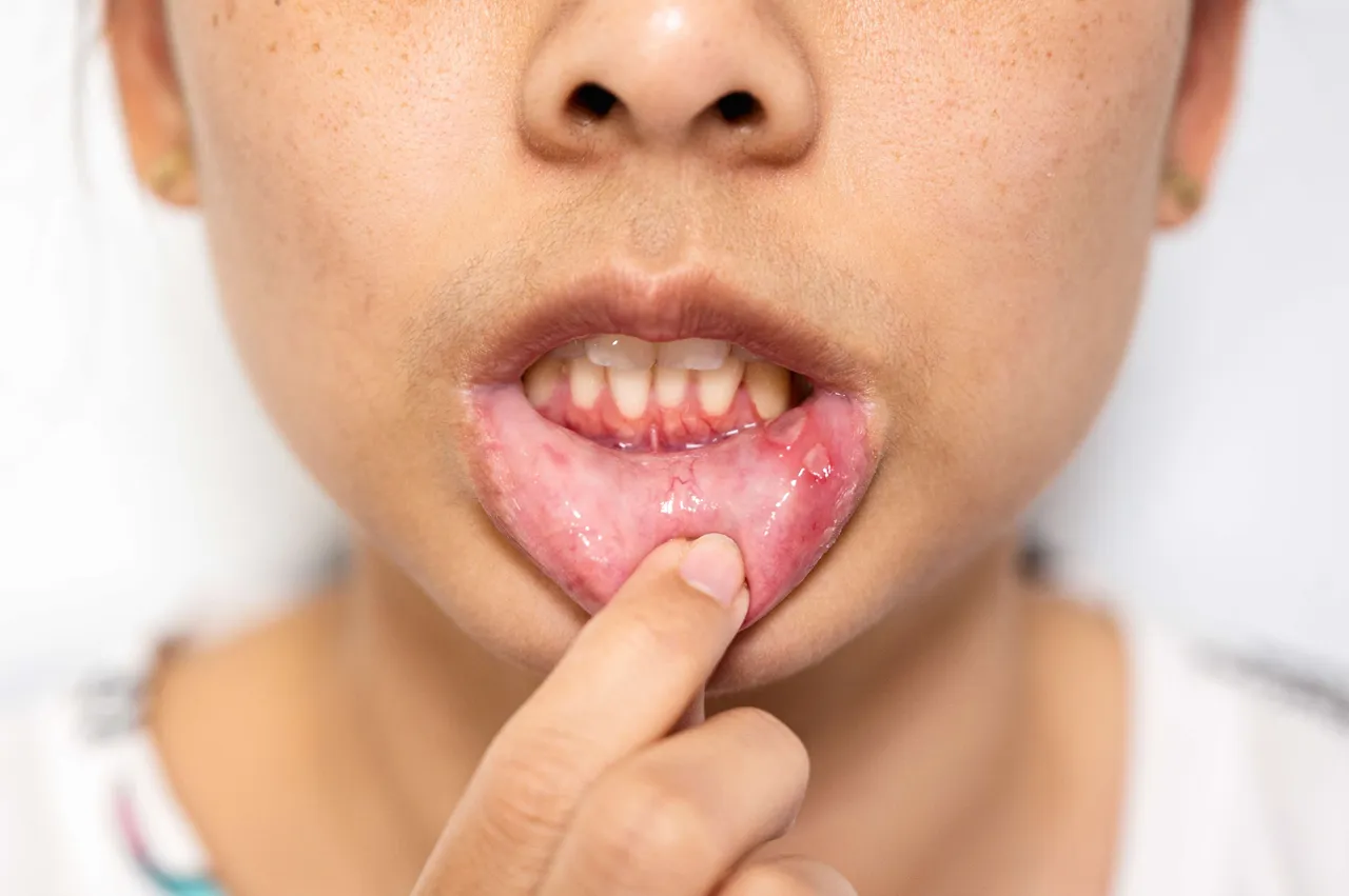 mouth ulcers