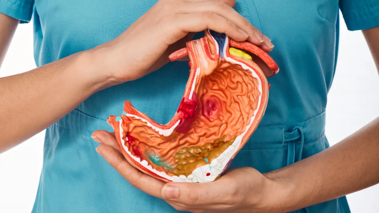 Stomach Ulcers