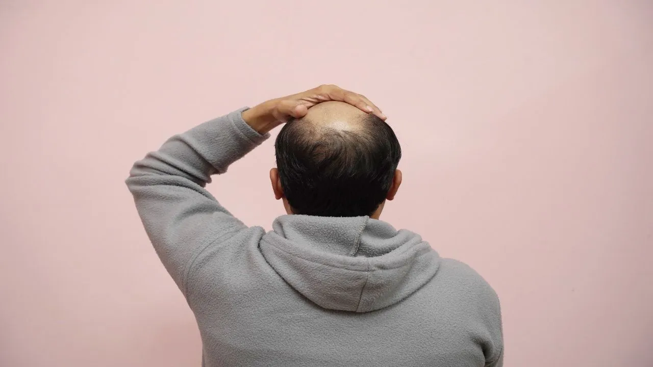 baldspotshead1