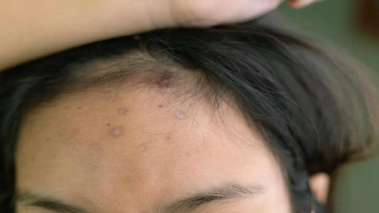 baldspotshead8