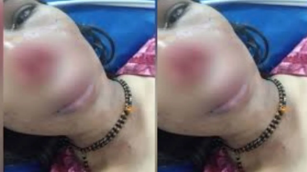 Karnataka Husband Bites Wife Nose