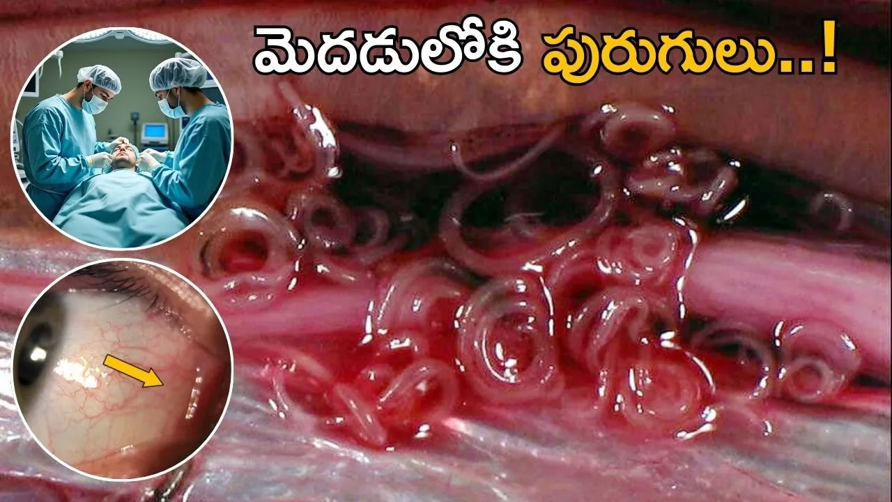 Worm in Human Eye