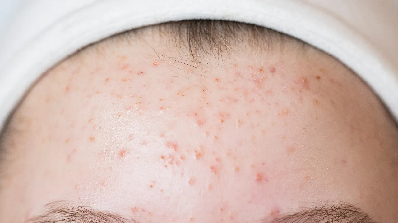 pimples