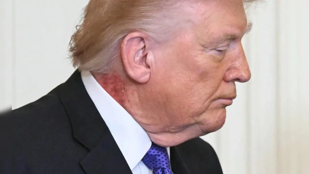 Trump Appears With Red Rash On Neck, Officials Say Caused By Skin Cream